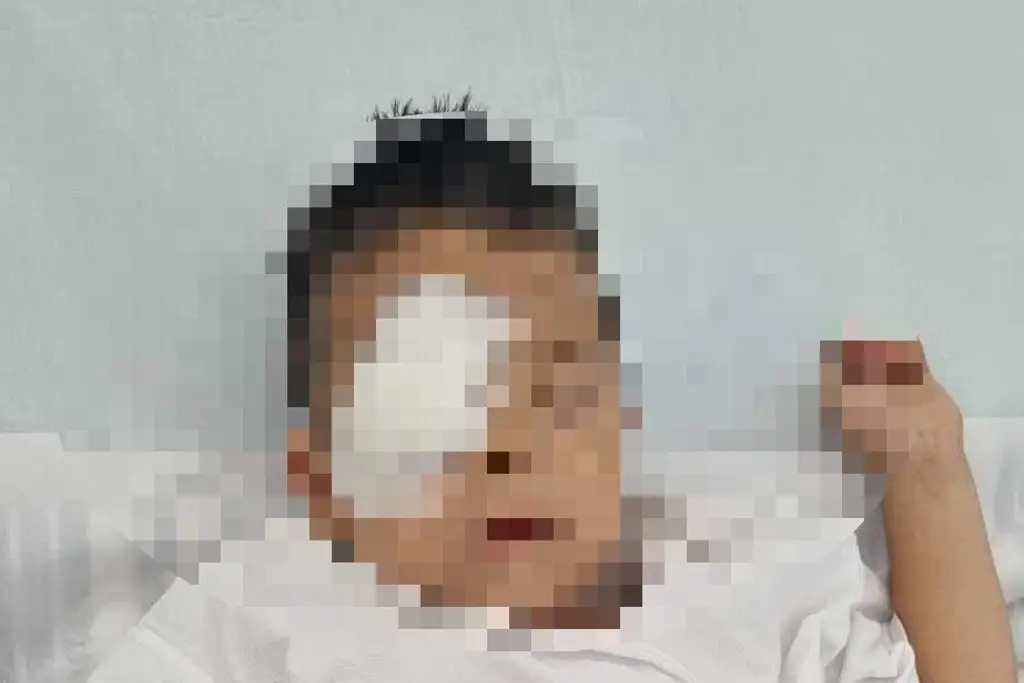 Niño de 5 años, a punto de perder el ojo tras explotar pirotecnia al sur de Veracruz