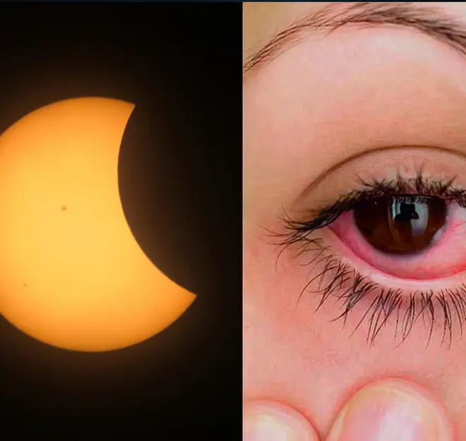 ¿Por qué me duelen los ojos?: búsqueda en Google aumenta después del eclipse solar