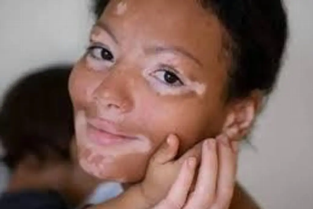 Hoy 25 de junio es el Día Mundial del Vitiligo ¿Por qué se celebra?