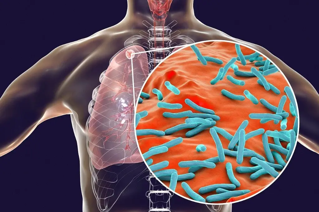 Cetmar de Alvarado reporta estudiante con tuberculosis; suspenden actividades