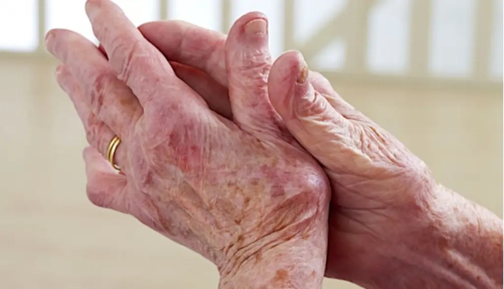 Hoy se conmemora el Día Mundial del Parkinson
