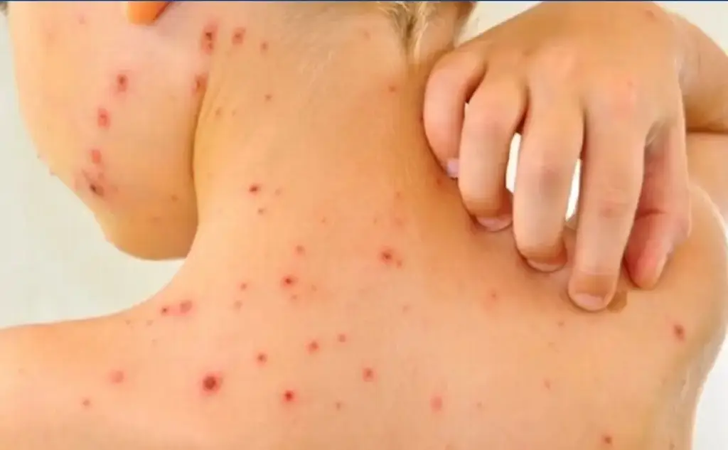 Muere bebé de 2 años por sarampión en Chihuahua: suman 5 muertes en el país