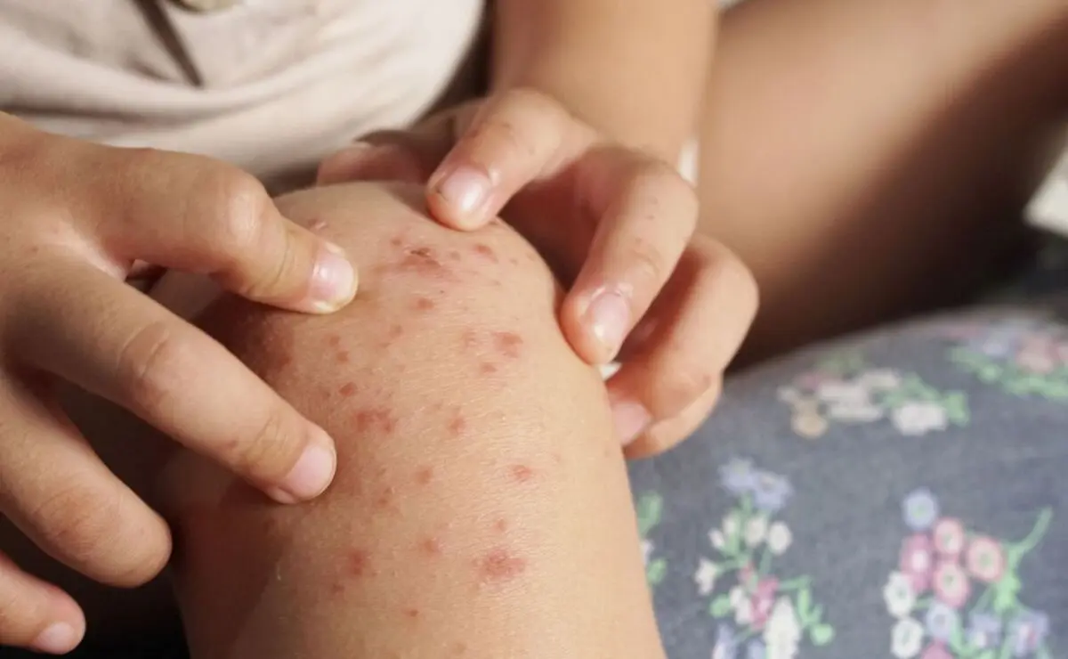 Suspenden clases en Minatitlán por dengue y virus Coxsackie