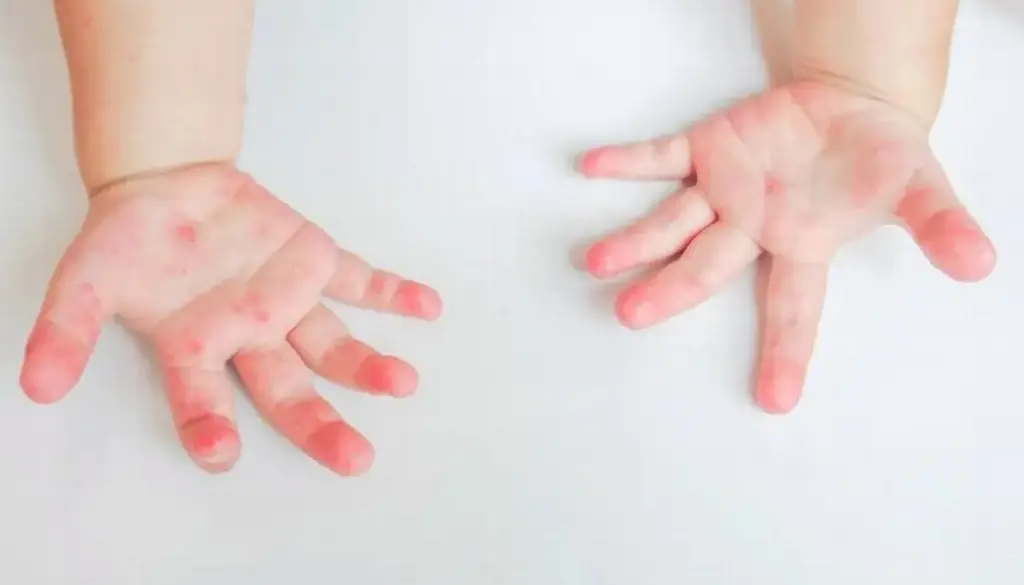 Virus coxsackie, enfermedad que afecta a menores de cinco años en Veracruz