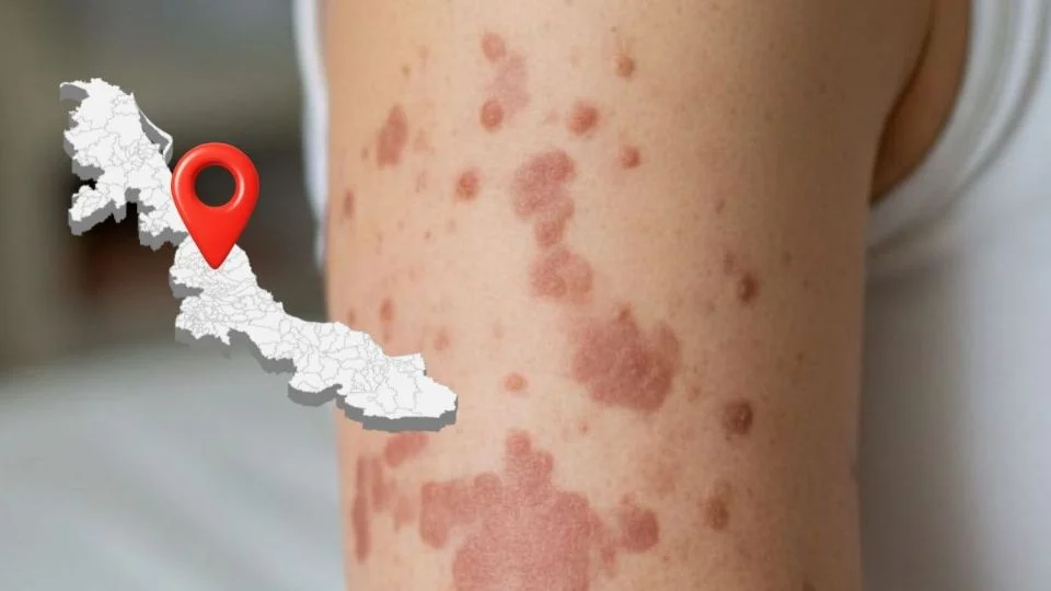 El municipio de Veracruz con contagio de sarampión 2026, tras brote nacional