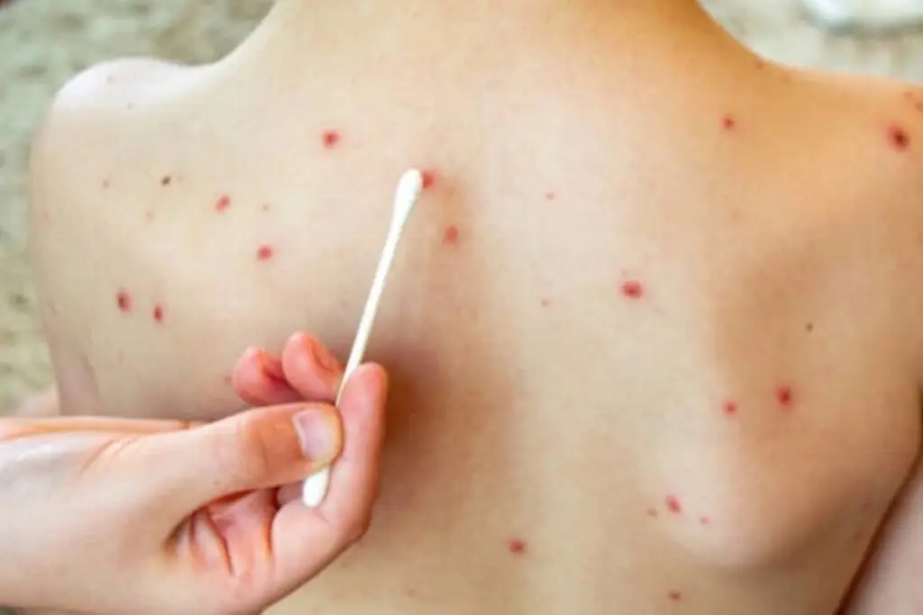 Confirman muerte de niño por sarampión y su gemelo también está contagiado