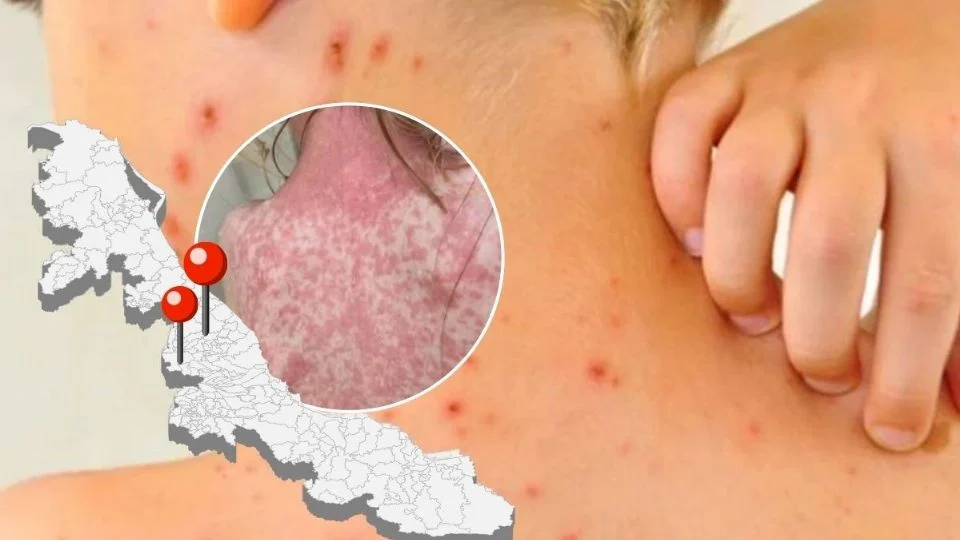 Aumenta sarampión en Veracruz: así ha avanzado el brote en Xalapa y Orizaba