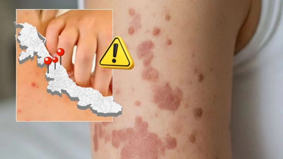 Sarampión llega a Veracruz puerto; crece brote a 21 casos en 9 municipios