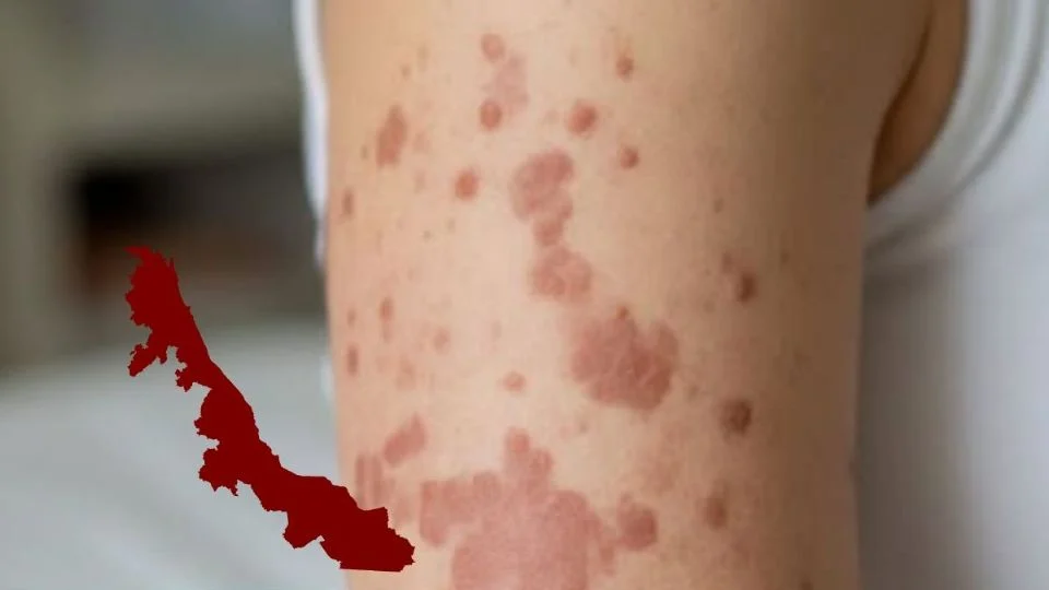 La vez que el sarampión en Veracruz dejó 26 niños muertos hace 37 años