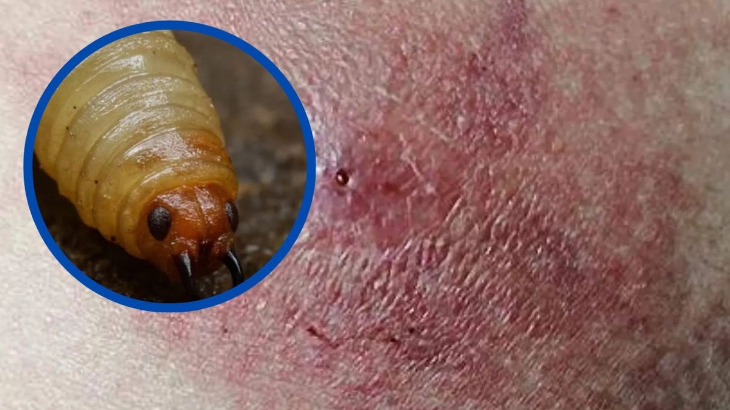 Emiten alerta sanitaria por caso de miasis por gusano barrenador en humanos; ¿cuáles son los síntomas y cómo ocurre la infección?