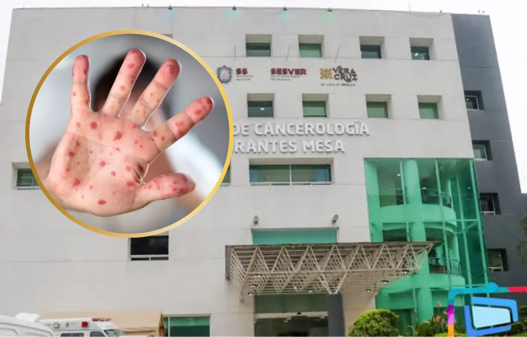 Brote de sarampión en el Cecan de Xalapa deja dos muertos y 16 casos confirmados